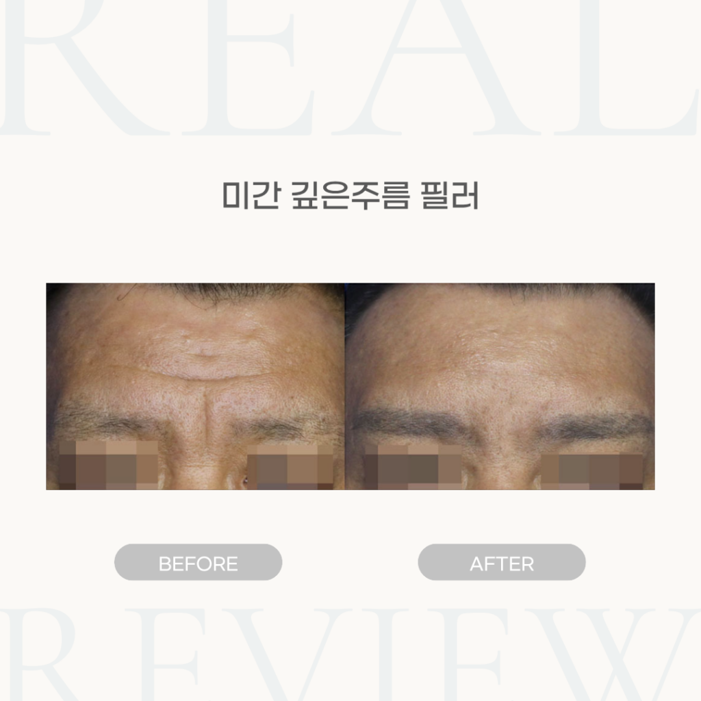 미간 깊은주름 필러