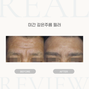 미간 깊은주름 필러