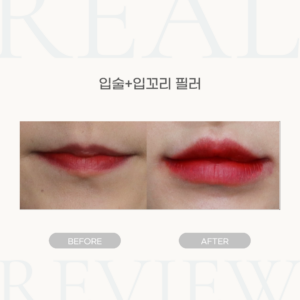 입술+입꼬리 필러