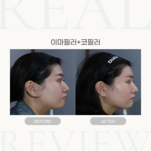 이마필러+코필러