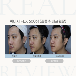 써마지 FLX 600샷 (김중수 대표원장)