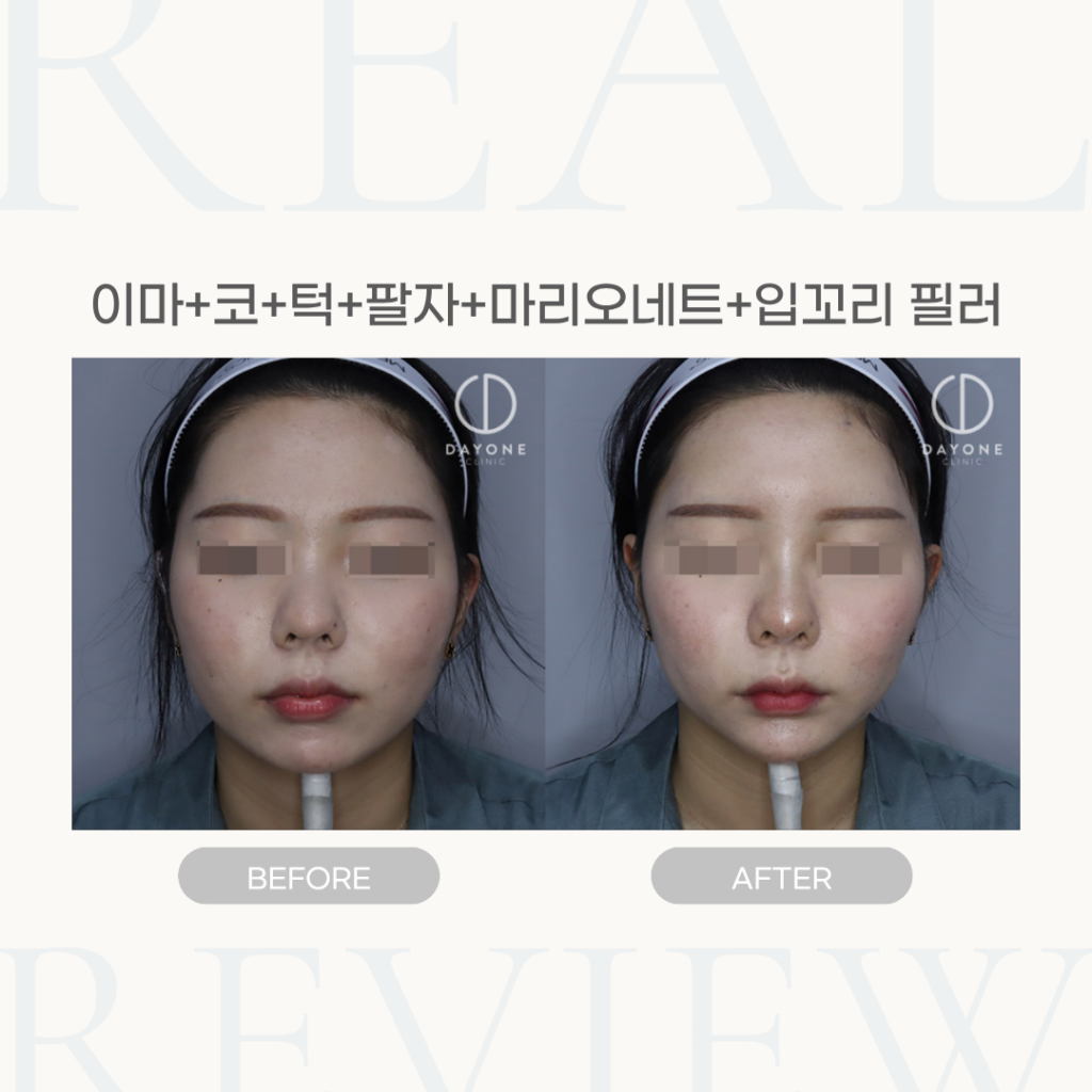 이마+코+턱+팔자+마리오네트+입꼬리 필러