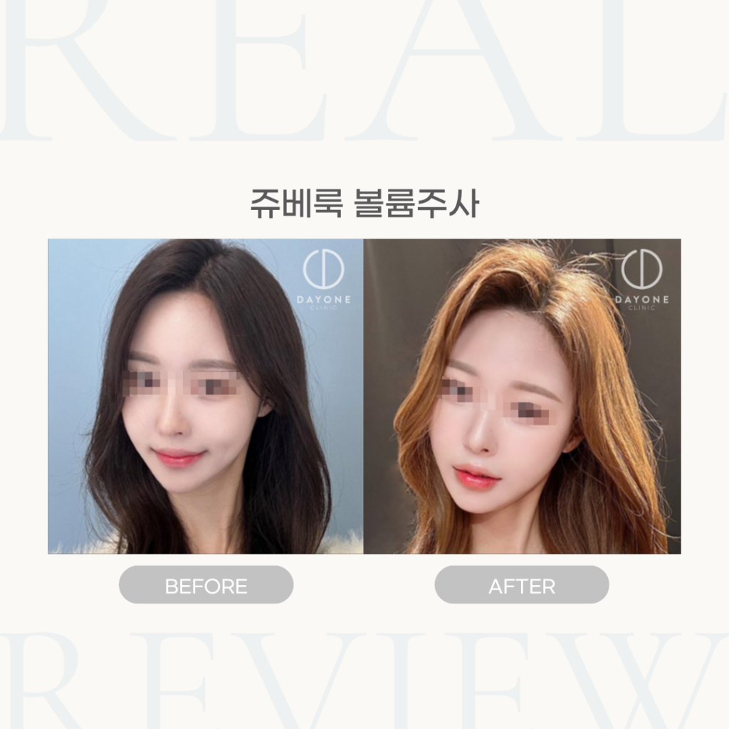 쥬베룩 볼륨주사