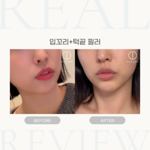 입꼬리+턱끝 필러