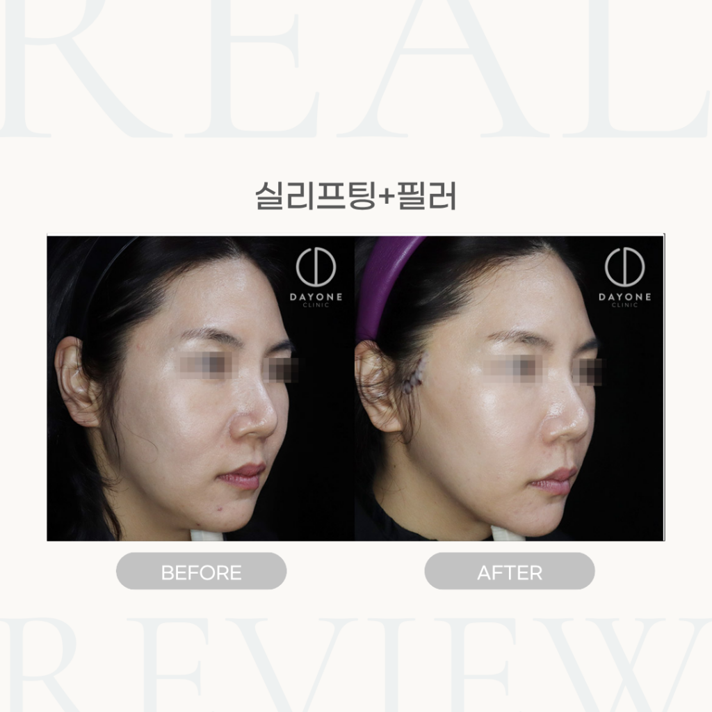 실리프팅+필러(눈밑, 팔자)