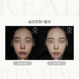 실리프팅(광대,턱라인)+필러(이마,눈밑,팔자,마리오넷트,코,볼,입술)