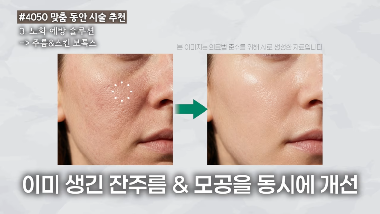 스킨보톡스 잔주름 모공 개선 전후 비교