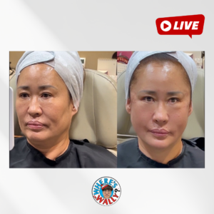 평창에서 오신 61세 여성 5년 어려지는 과정 상담 부터 시술까지!