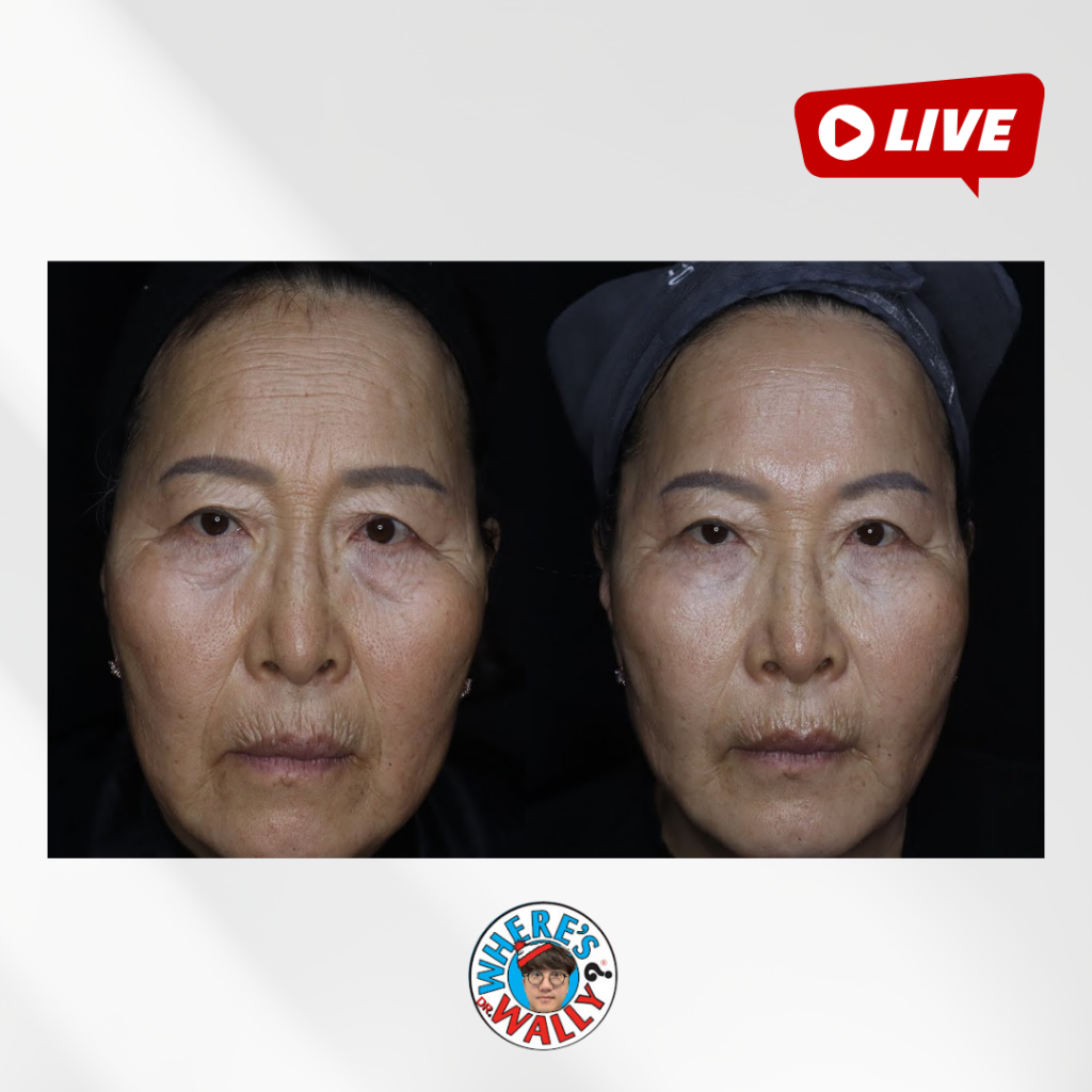 경북 봉화에서 오신 61세 어머니 12월 28일 시술 리터치 라이브!