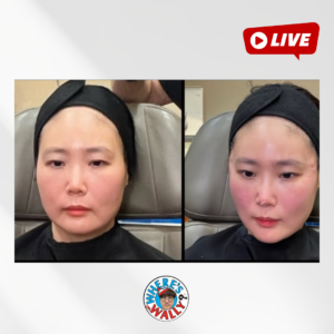 40세 여자분 리프팅, 뭐가 필요할까요? 오른쪽 얼굴을 먼저 리프팅 해 보았어요!
