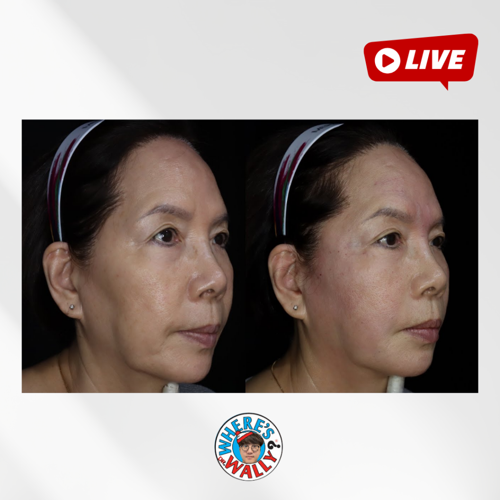 닥터 월리의 장모님(69세) 리프팅 라이브!!