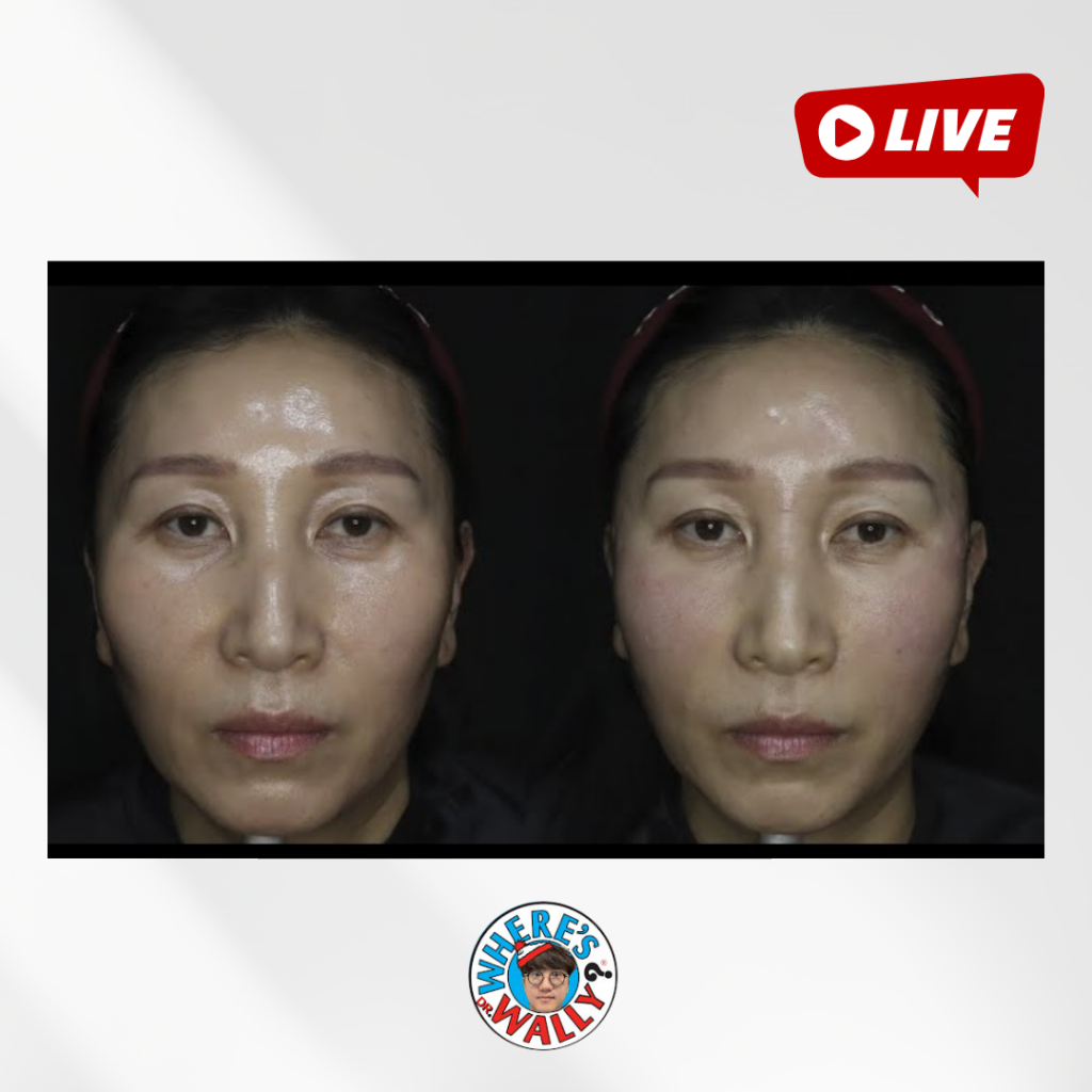 갑자기 살이 빠진 50대, 땅콩형 얼굴 광대축소 라이브!