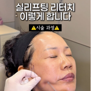 실리프팅 리터치 이렇게 합니다_시술과정 공개