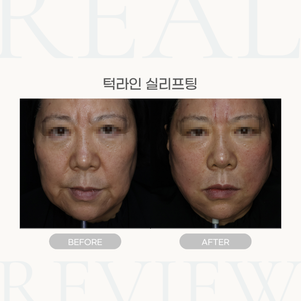 턱라인 실리프팅 (60세 여성)