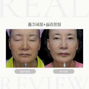 줄기세포+실리프팅 (73세 여성)
