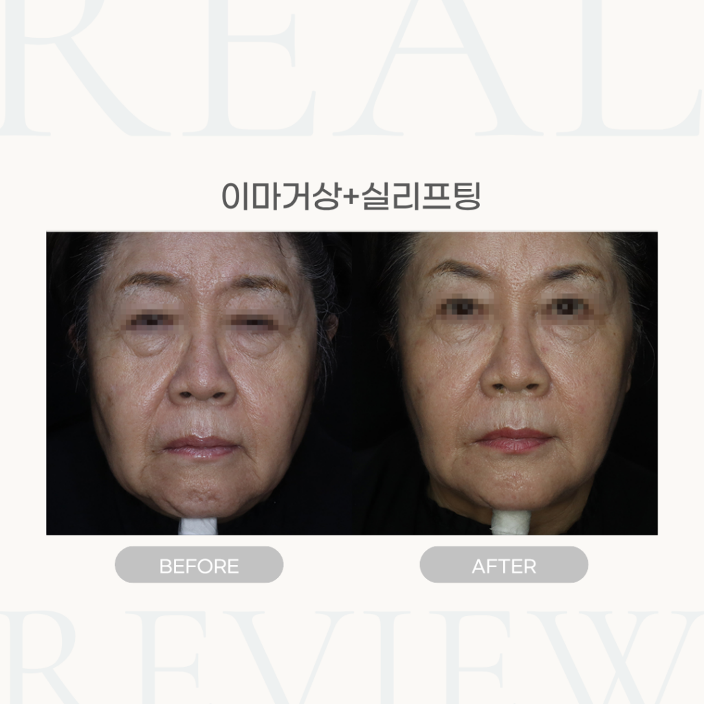 이마거상+실리프팅 (73세 여성)