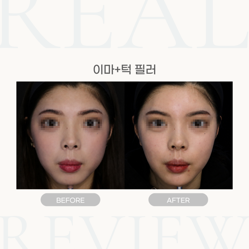 이마+턱 필러 (25세 여성)