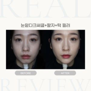 눈밑다크써클+팔자+턱 필러 (27세 여성)