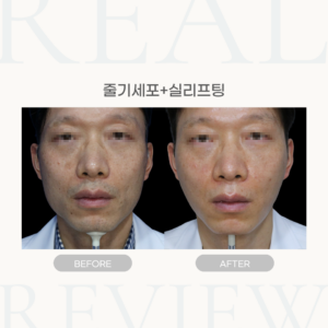 줄기세포 (53세 남성)