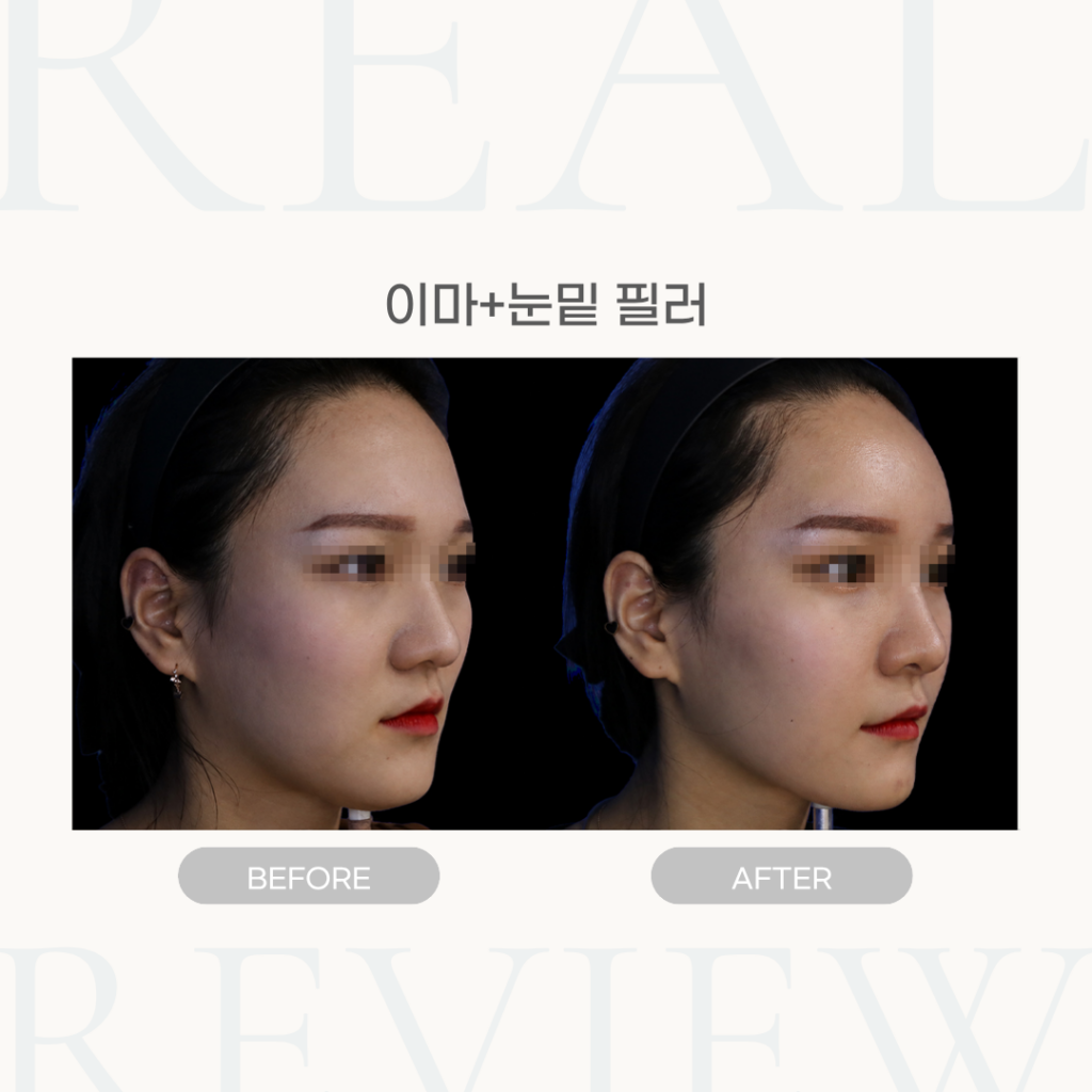 이마+눈밑 필러