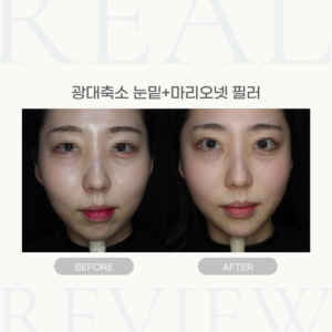 광대축소 눈밑+마리오넷 필러 (30세 여성)