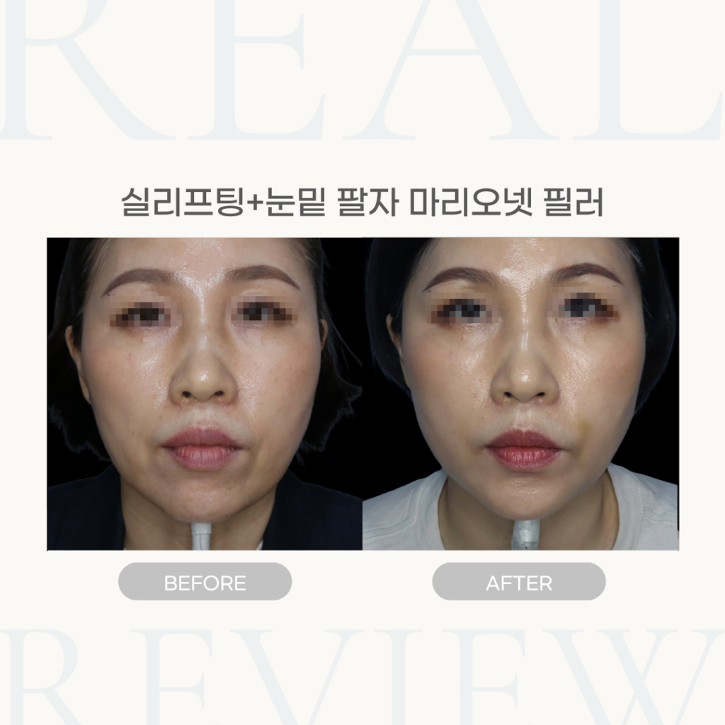 실리프팅+눈밑 팔자 마리오넷 필러 (52세 여성)