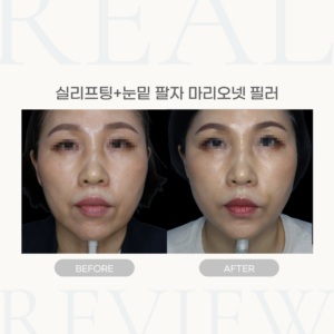 실리프팅+눈밑 팔자 마리오넷 필러 (52세 여성)